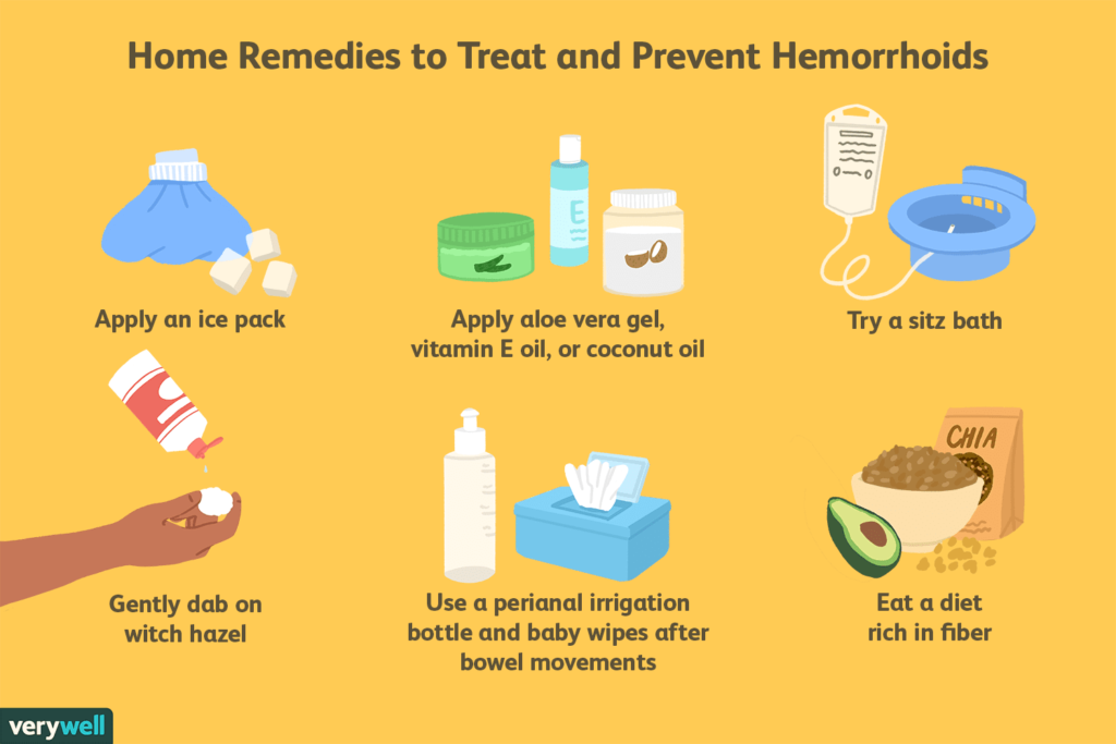Preventing Hemorrhoids During Pregnancy: Diet and Lifestyle Tips Lifestyle Tips to Prevent Hemorrhoids