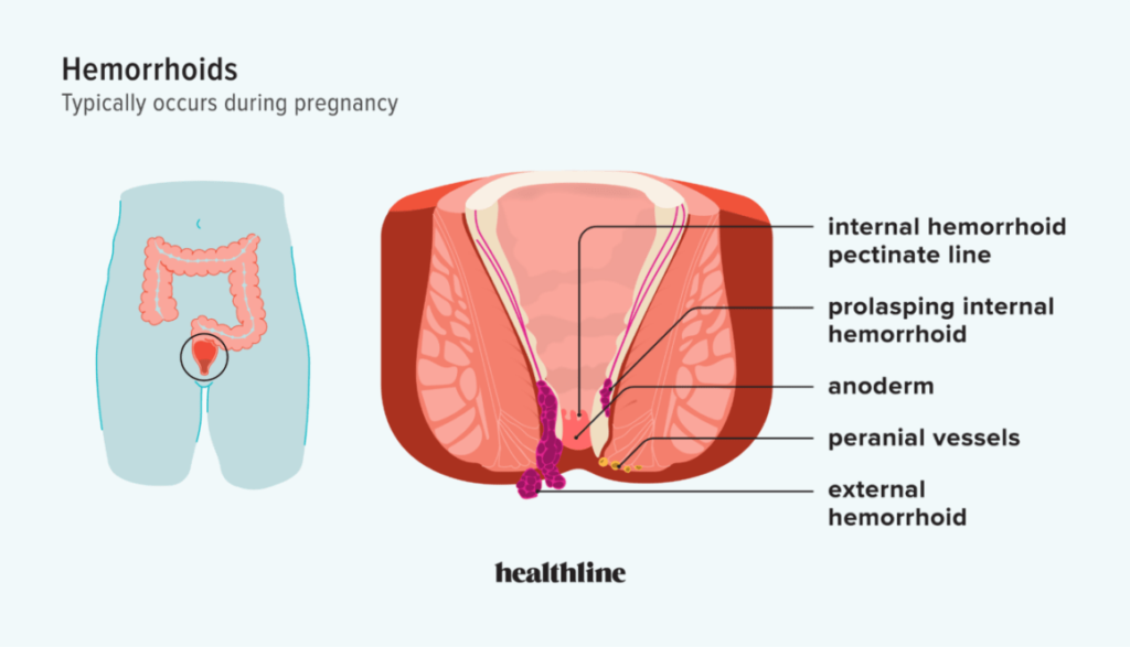 Understanding Hemorrhoids During Pregnancy: Causes and Solutions Medical Treatments for Hemorrhoids During Pregnancy