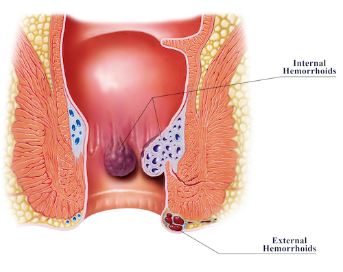 Uncovering the Roots of Hemorrhoids Causes of Hemorrhoids