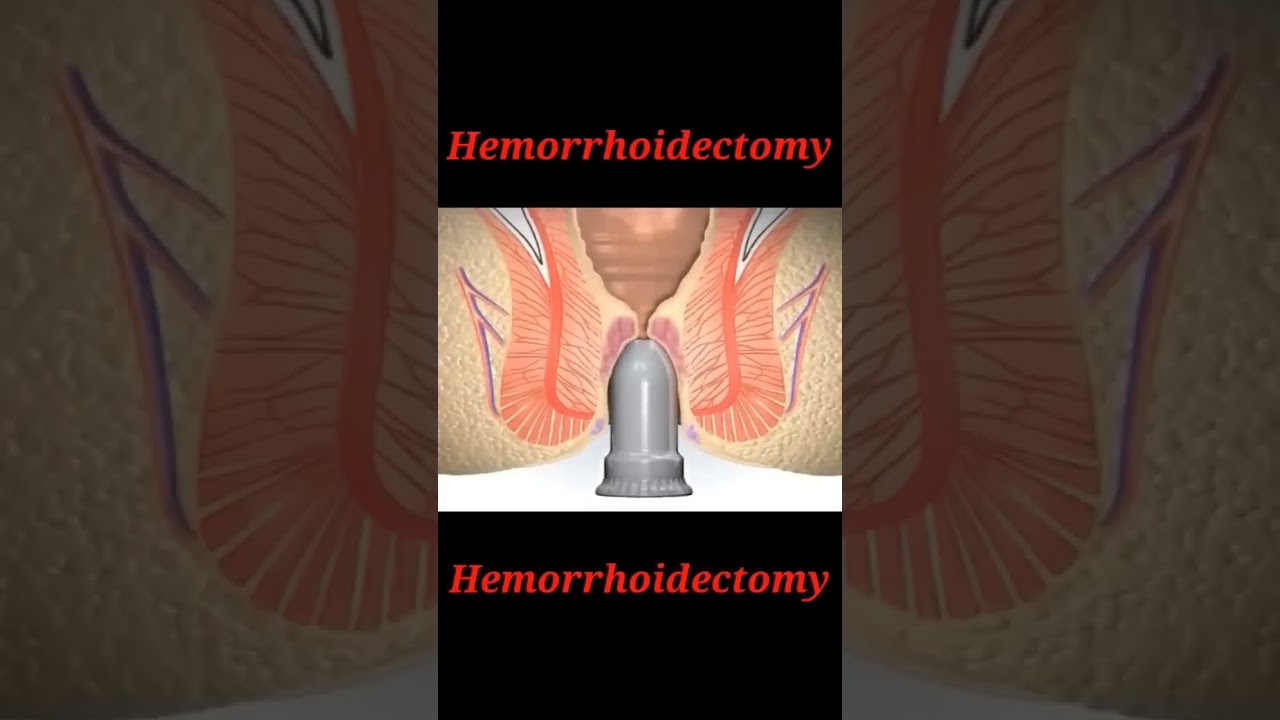 Hemorrhoidectomy || Hemorrhoids Operation #shorts