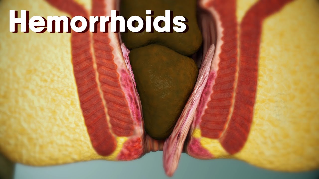 Hemorrhoids|different types of hemorrhoids| internal and external Hemorrhoids| Hemorrhoids treatment